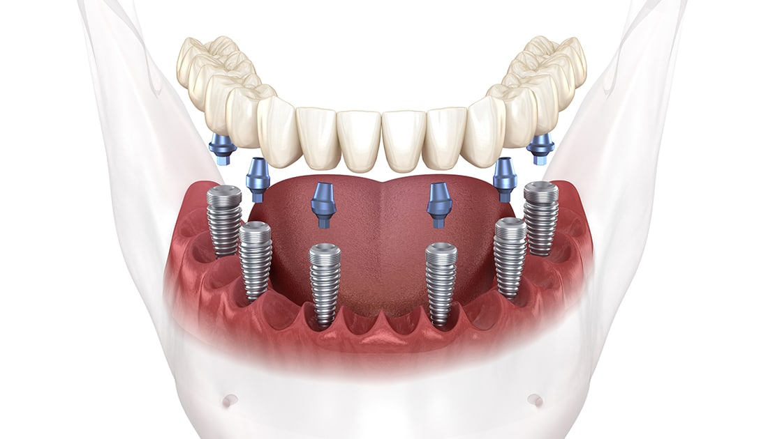 Implant Supported Dentures